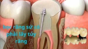 bọc răng sứ có phải lấy tủy răng