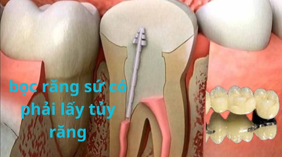 bọc răng sứ có phải lấy tủy răng
