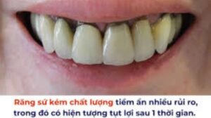 bọc răng sứ có thể gây hôi miệng do tụt nướu-viêm nha chu