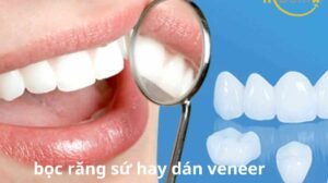bọc răng sứ hay dán sứ veneer
