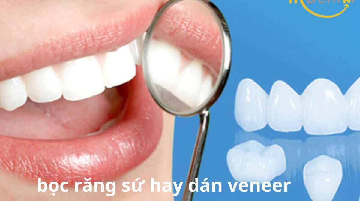 bọc răng sứ hay dán sứ veneer