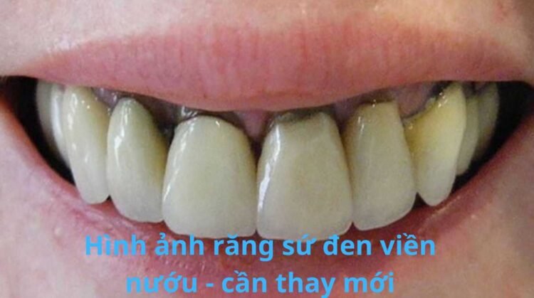 hình ảnh răng sứ đen viền nướu - cần thay mới