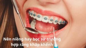 Nên niềng hay bọc sứ trường hợp răng khấp khểnh