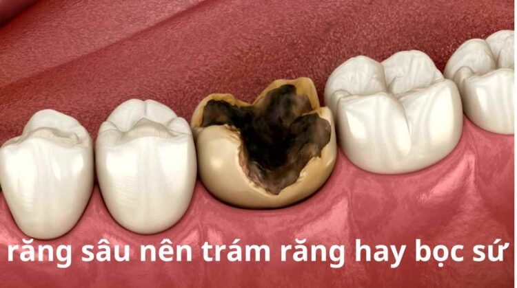 răng sâu nên trám răng hay bọc sứ